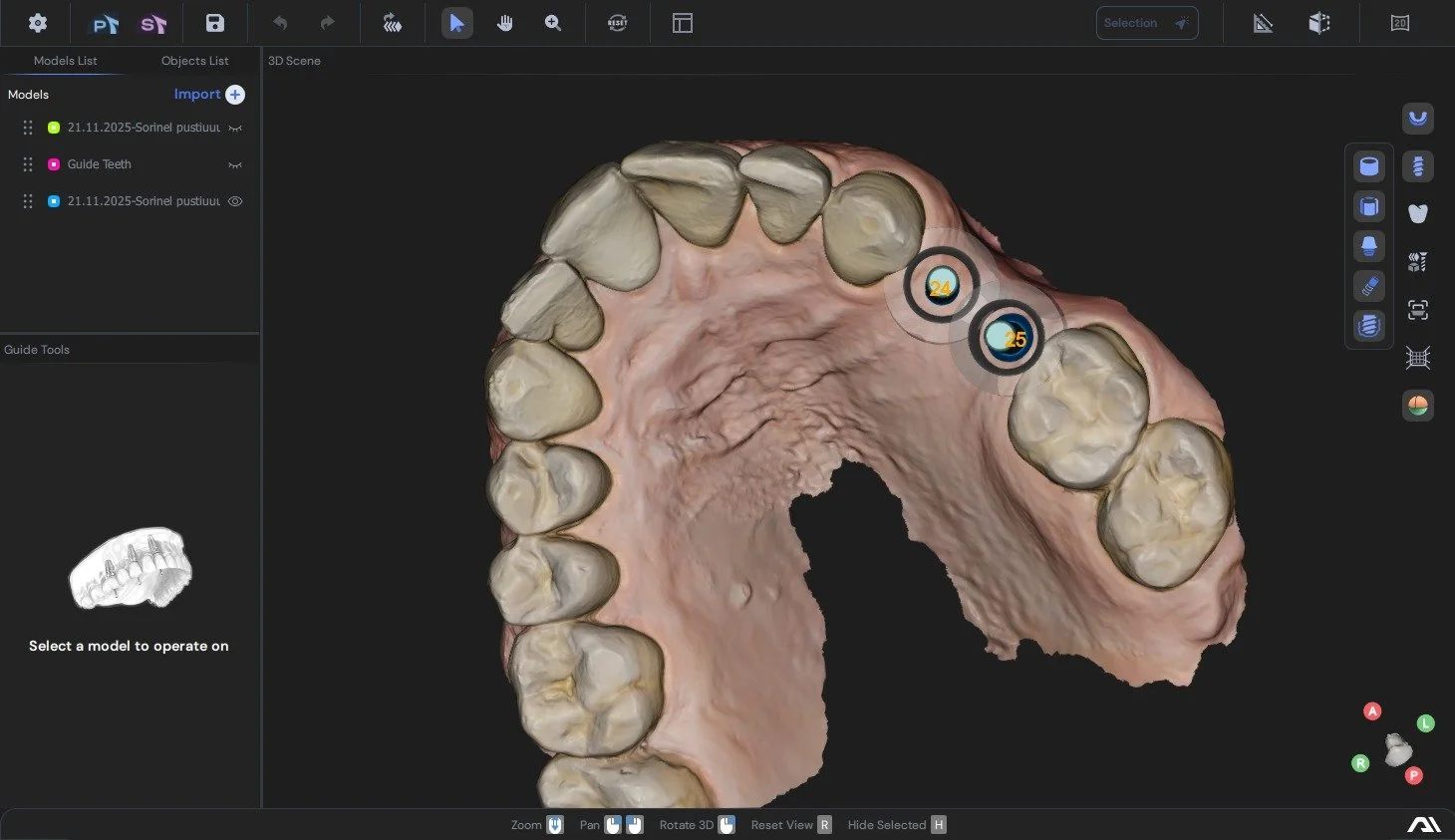 3D digital model of the upper teeth of a human mouth showing dental anatomy and implants in a dental CAD software interface.