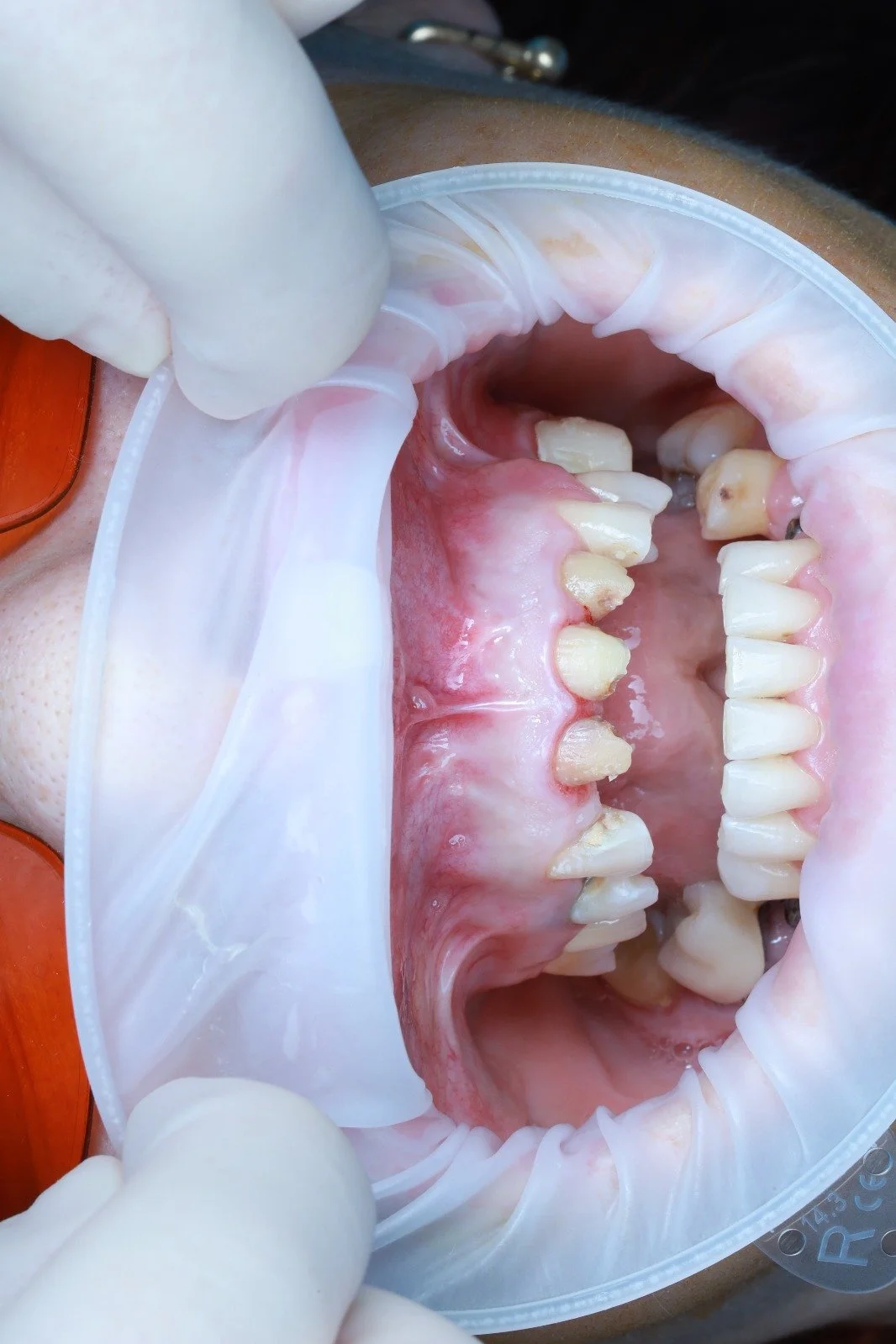 chirurgie ghidată digitală • flapless • implantologie digitală • curs implantologie • ghiduri chirurgicale • planificare CBCT • Live OP • workflow implantologic