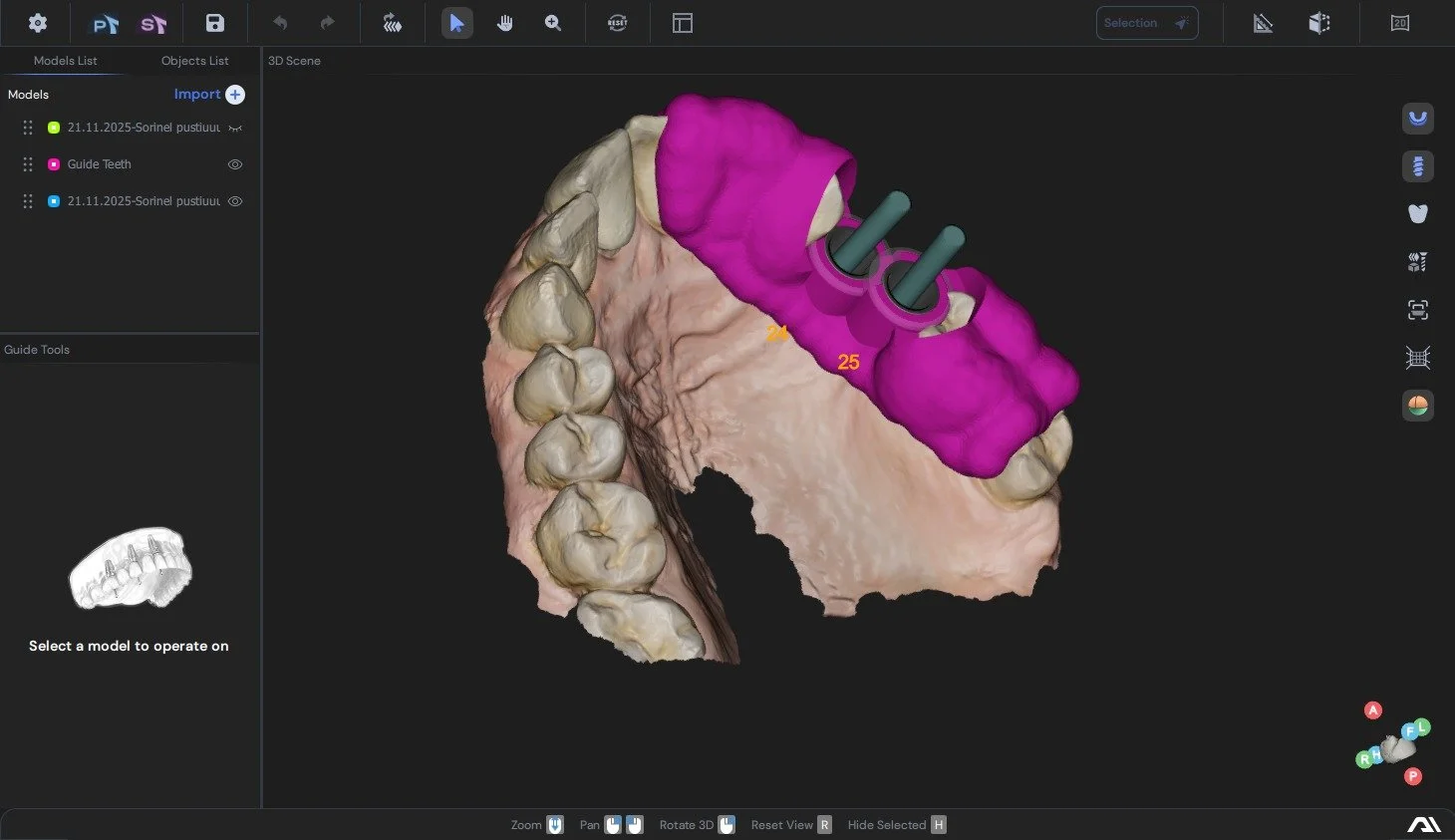 chirurgie ghidată digitală • flapless • implantologie digitală • curs implantologie • ghiduri chirurgicale • planificare CBCT • Live OP • workflow implantologic