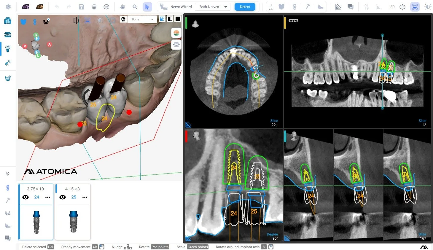 Dental implant planning software interface showing 3D visualization of teeth, CT scans, and marked implant positions with various annotations and measurements.