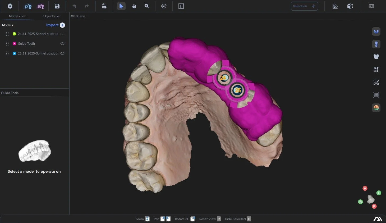 3D digital dental scan showing the upper jaw with a highlighted dental implant section in pink, numbered 24 and 25.