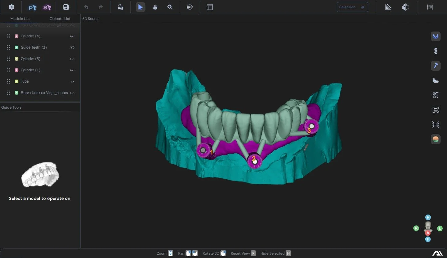 3D dental scan showing a model of lower teeth with dental implants labeled 1, 2, and 3, and surrounding jawbone and gum tissue.
