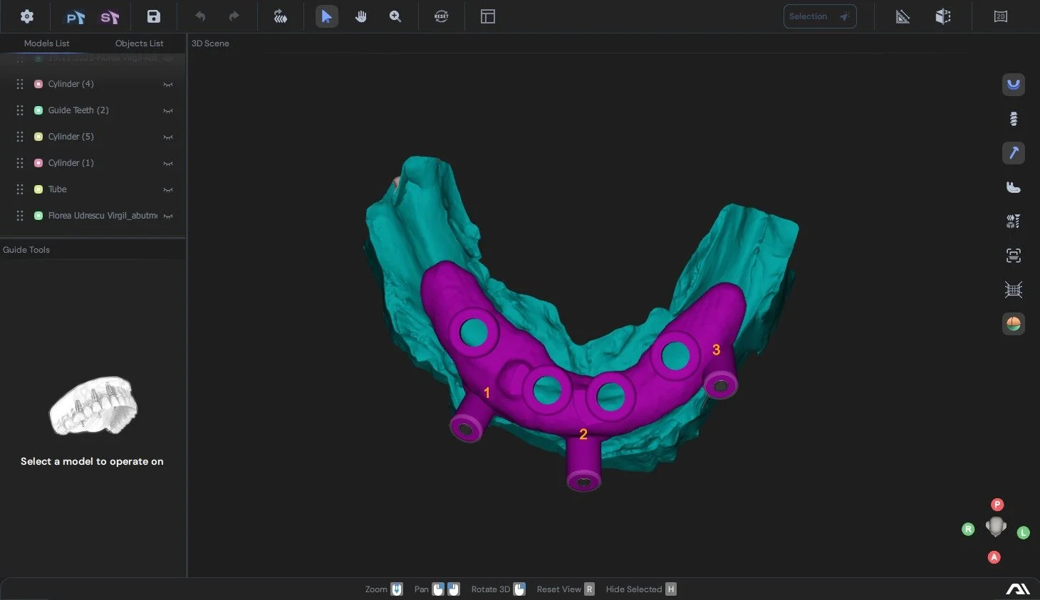3D digital model of a dental arch with purple implant components labeled 1, 2, and 3, situated on a teal-colored jawbone model.