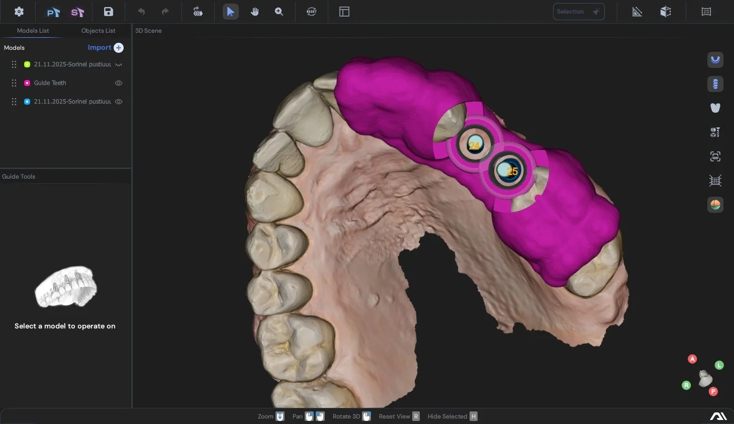 3D dental scan showing upper teeth with pink-colored dental implants and numbered circular markers.