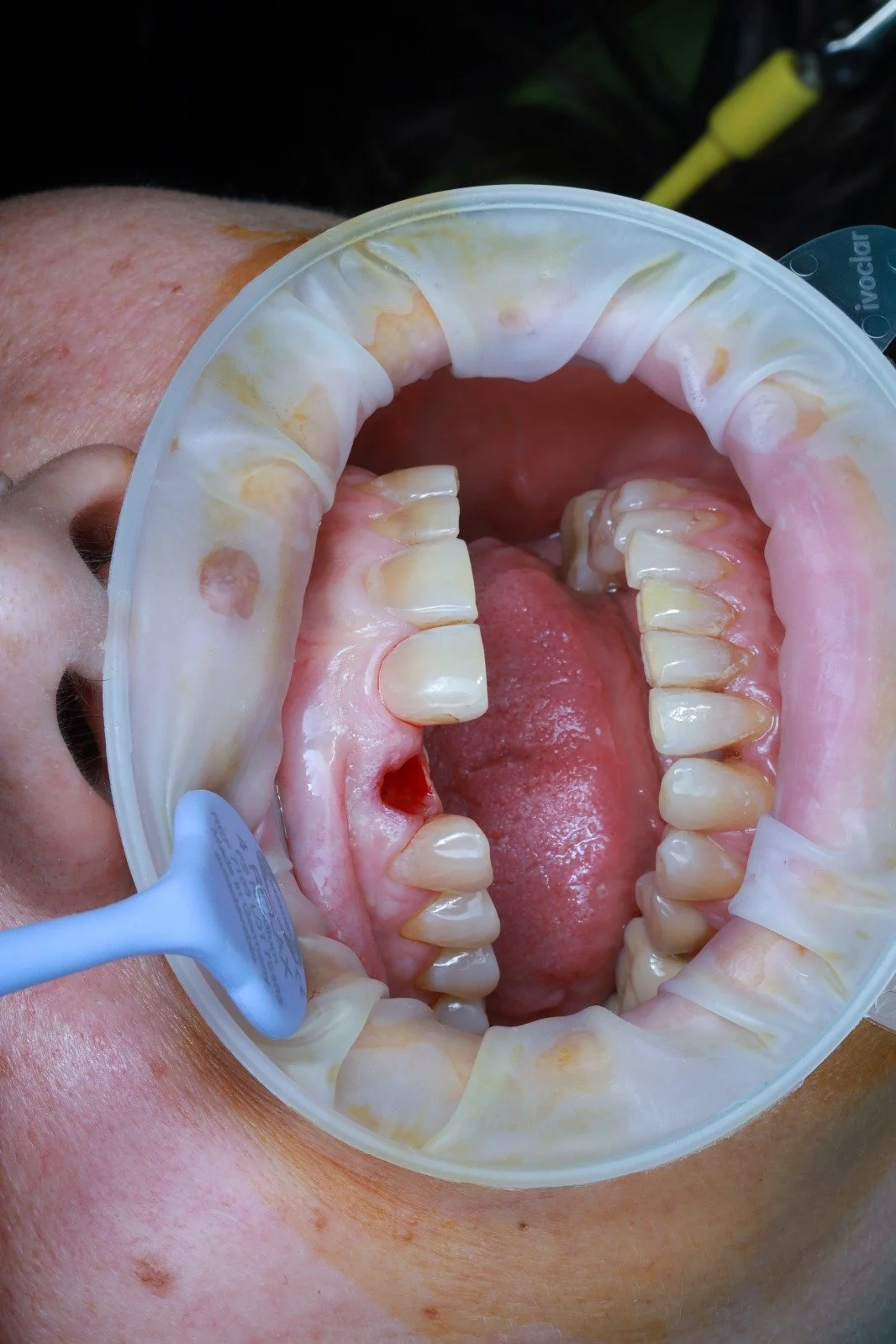 Open mouth with dental retractors showing teeth and gums during a dental examination or procedure.