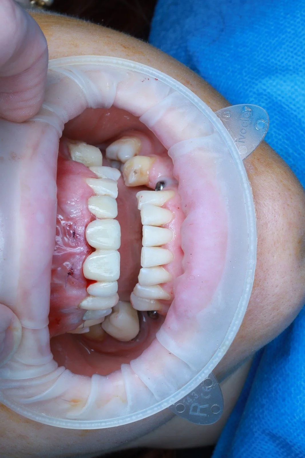 Close-up of a person's mouth with dental retractors, showing teeth and gums, some with dental work.