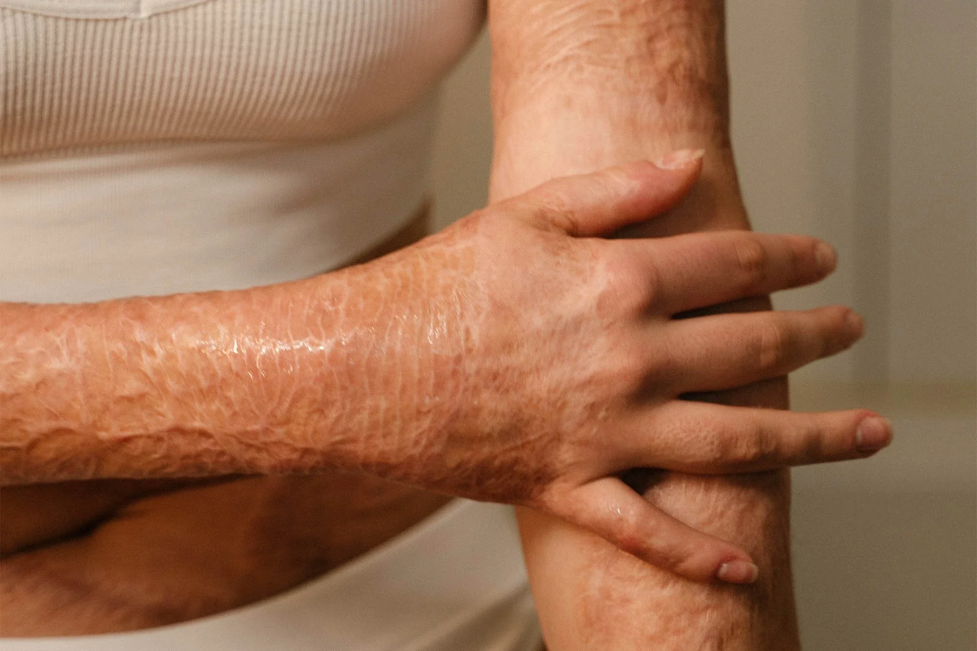 Close-up of a person's arm and hand with visible skin irritation or rash, holding another person's hand.