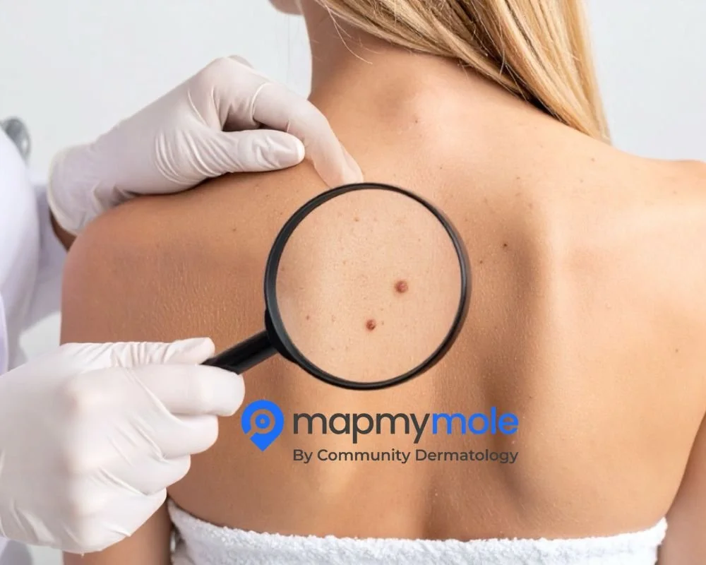 A close-up of a woman’s back with a health professional examining two mole spots using a magnifying glass. The professional is wearing gloves, and the background is clinical.