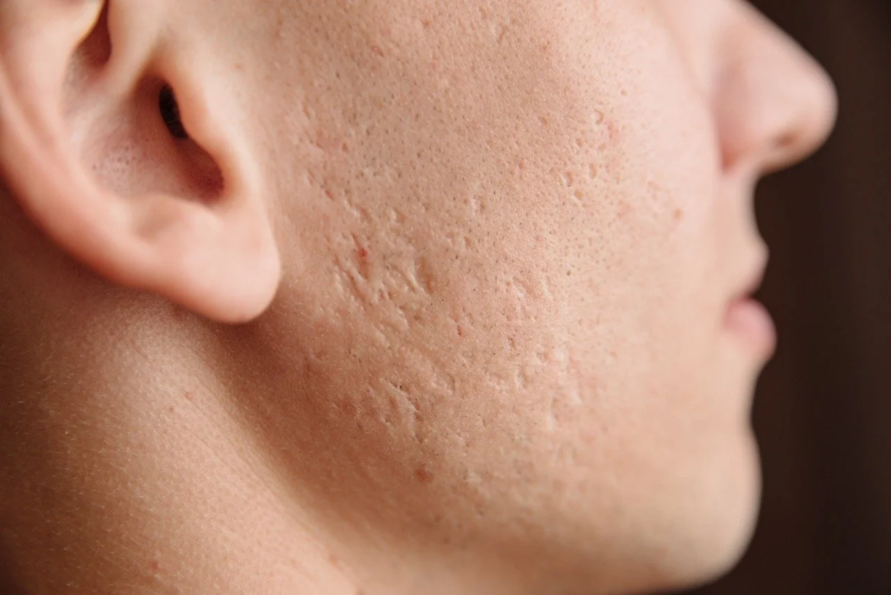 Close-up of a person's face showing skin with acne scars and uneven texture.