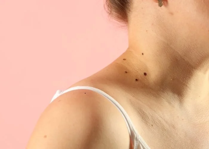 Close-up of a woman's shoulder and neck with multiple small moles, wearing a white tank top against a pink background.