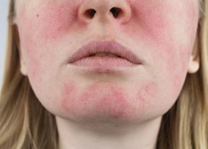 Close-up of a woman's face showing red, irritated skin on her cheeks, chin, and around her lips.