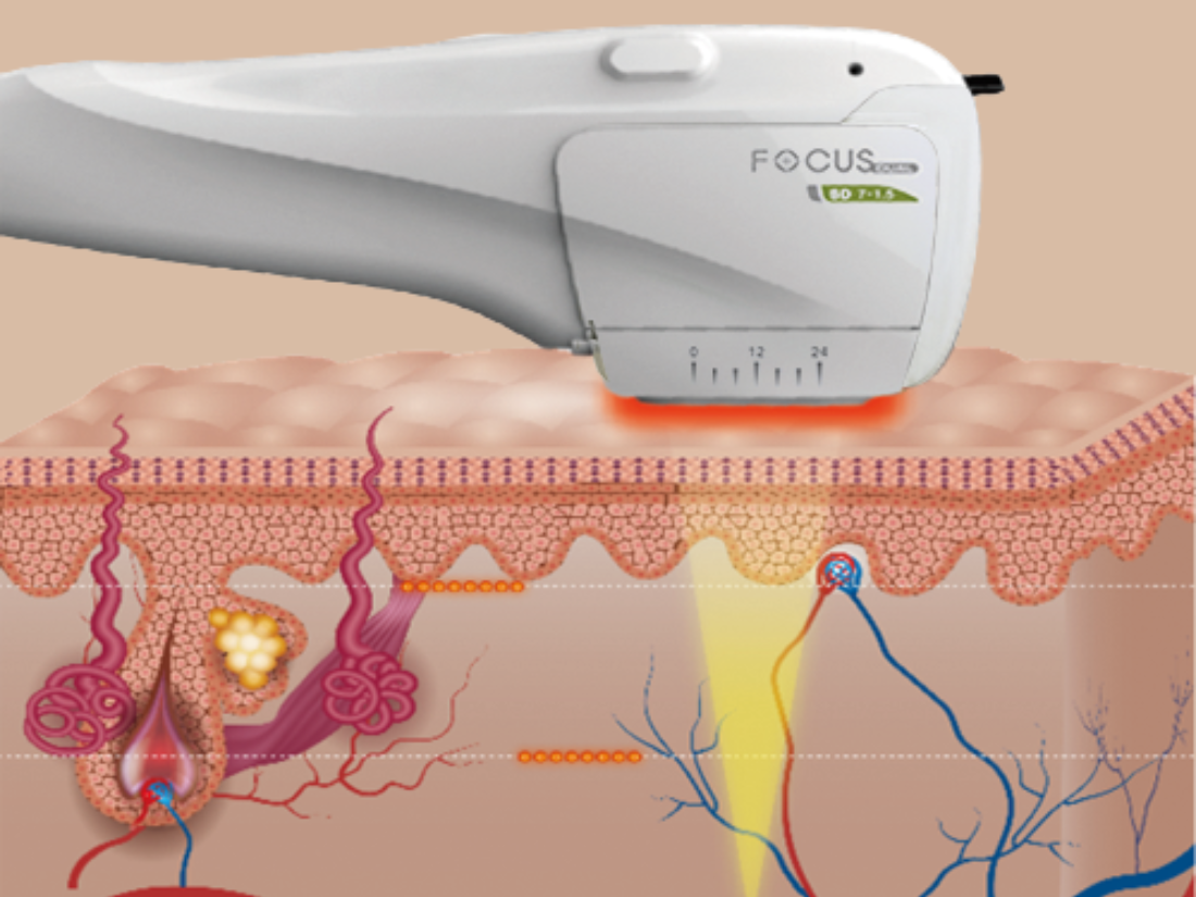 Diagram showing a laser skin treatment device targeting skin beneath the surface, illustrating the removal of bacteria, reduction of acne, and destruction of sebaceous glands.