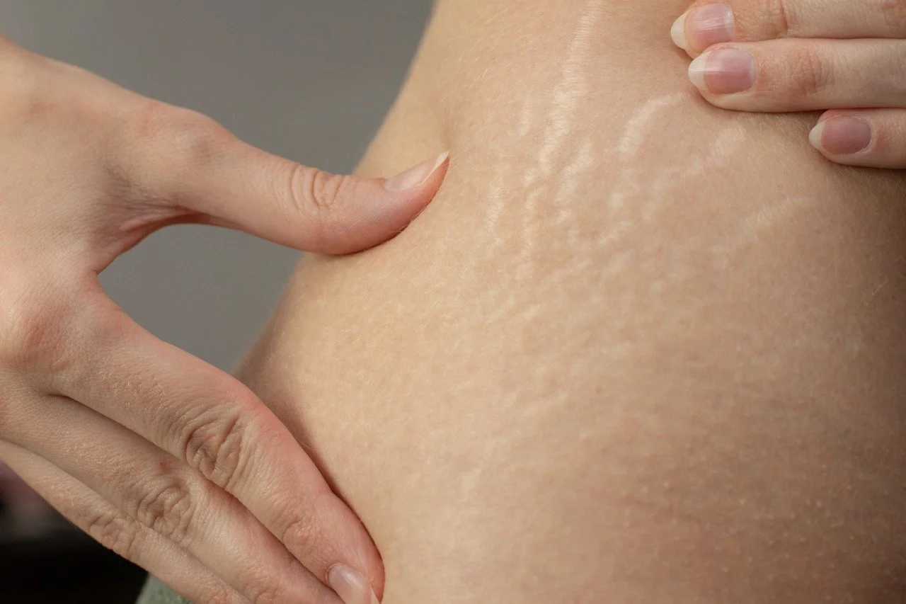 Close-up of a person examining their stretch marks on their skin.