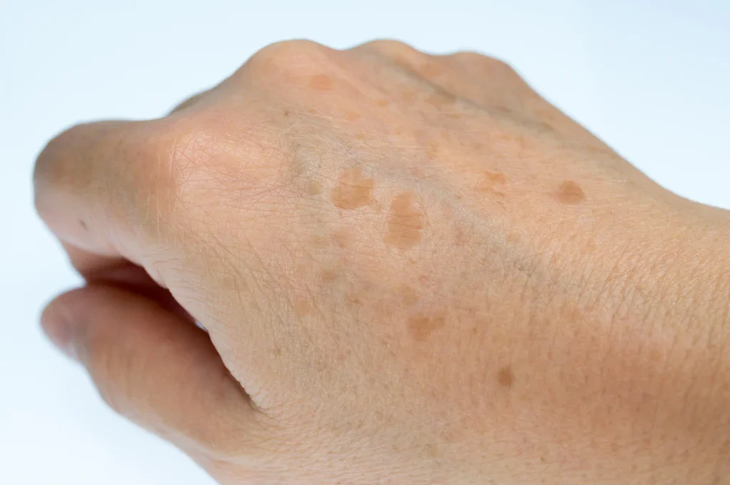 Close-up of a hand with multiple brown age spots or liver spots on the skin.