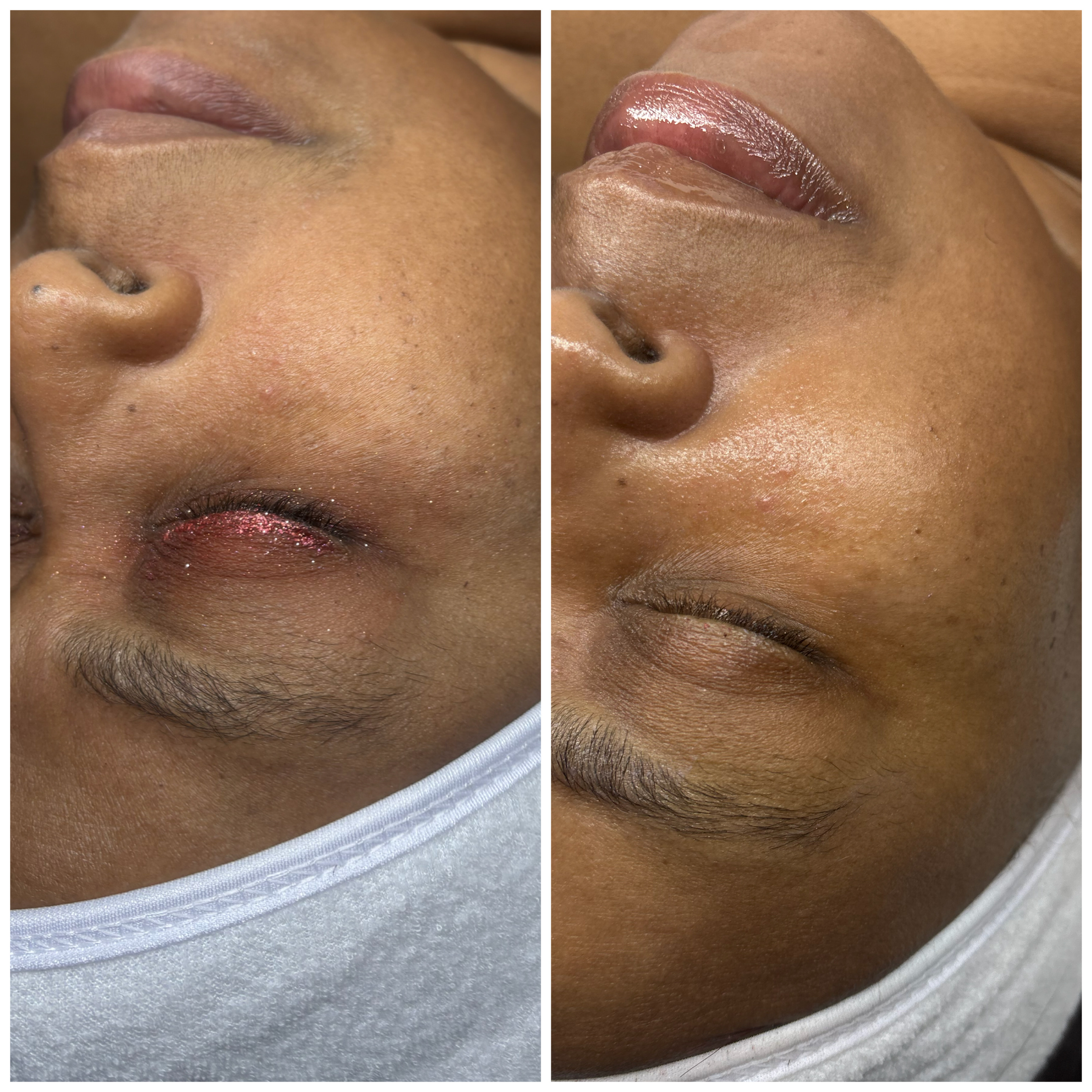 Visible skin improvement after customized facial treatment in Phoenix, AZ