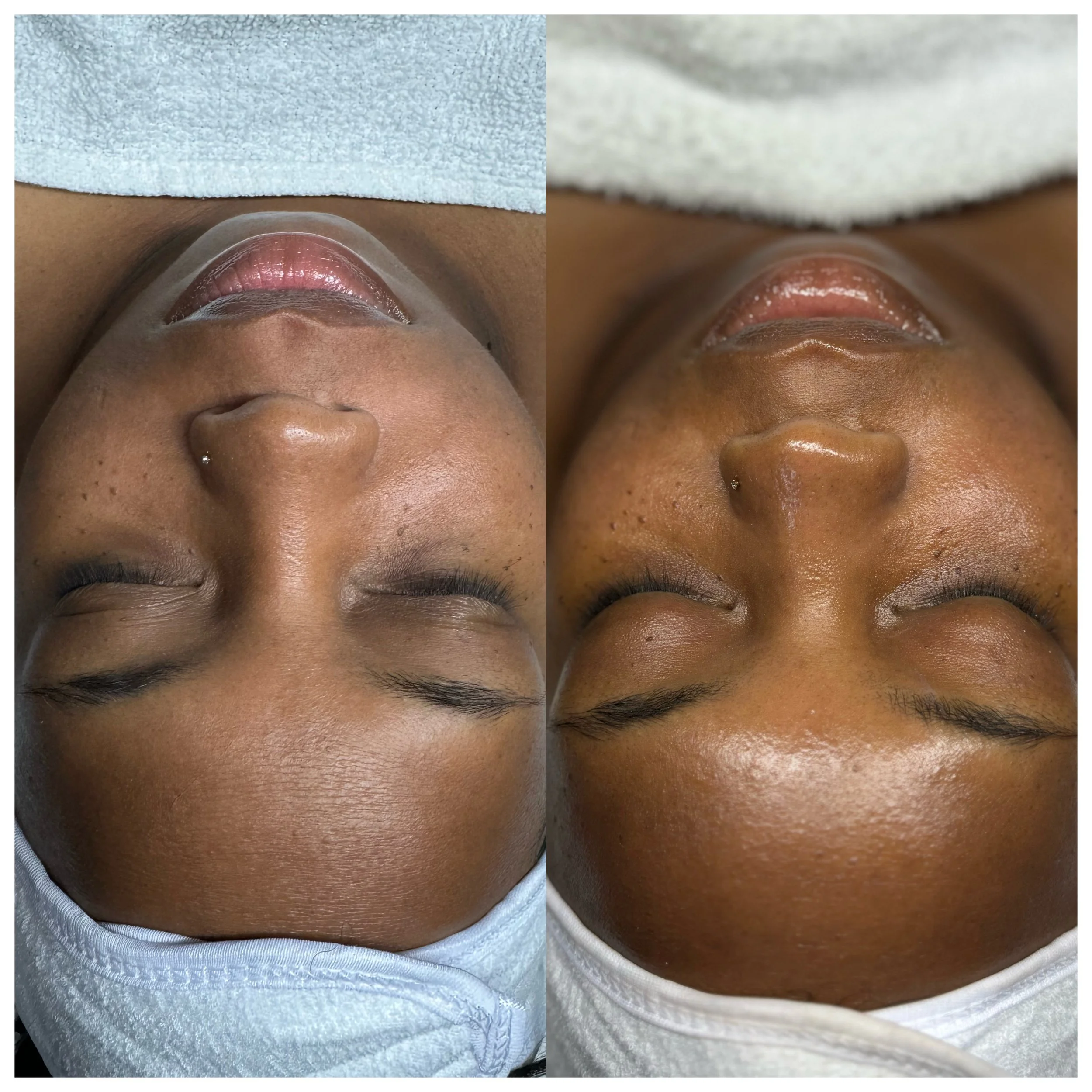 Custom facial before and after results at AuraGlow Skinlab in Phoenix, AZ