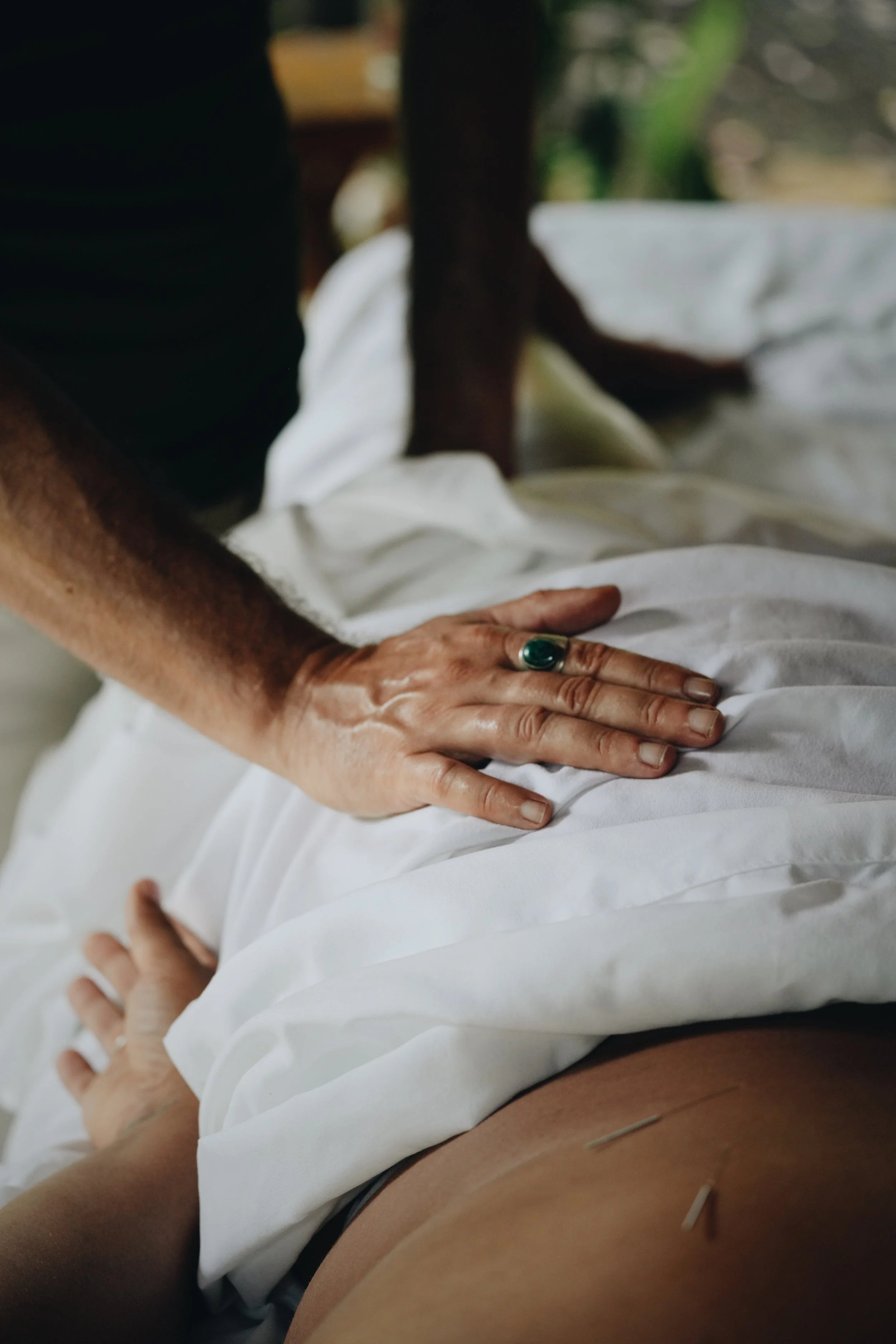 A person giving acupuncture treatment with their hand placed on a patient's abdomen, which has several acupuncture needles inserted.