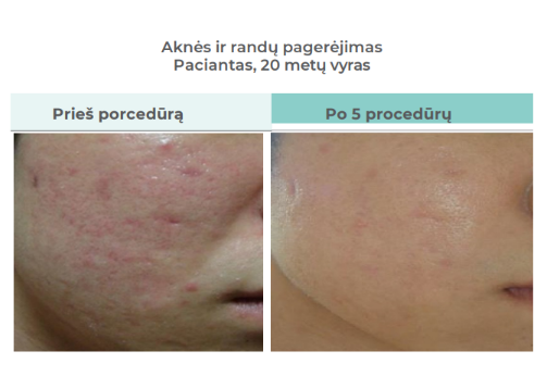Comparison of skin before and after five skincare procedures, showing reduced acne and smoother skin.