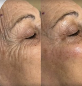 Comparison photo of a person's eye area showing reduction in wrinkles and fine lines after treatment.