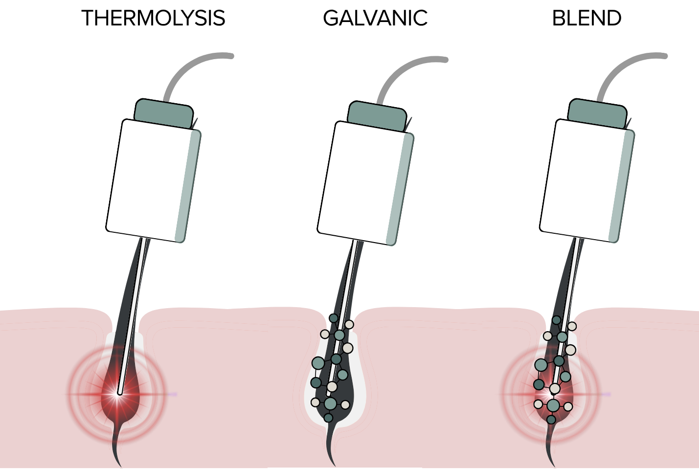 Illustration comparing thermolysis, galvanic, and blend electrolysis methods used for permanent hair removal.