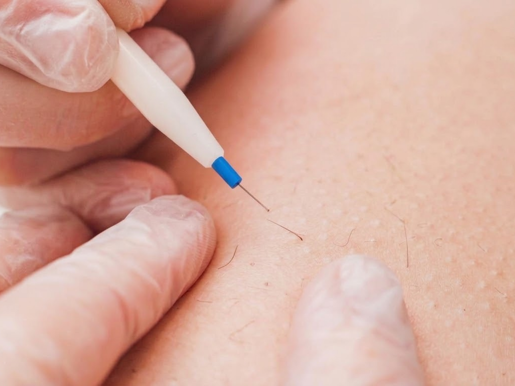 Close-up of a person receiving electrolysis hair removal, showing the probe near skin and gloved hands.