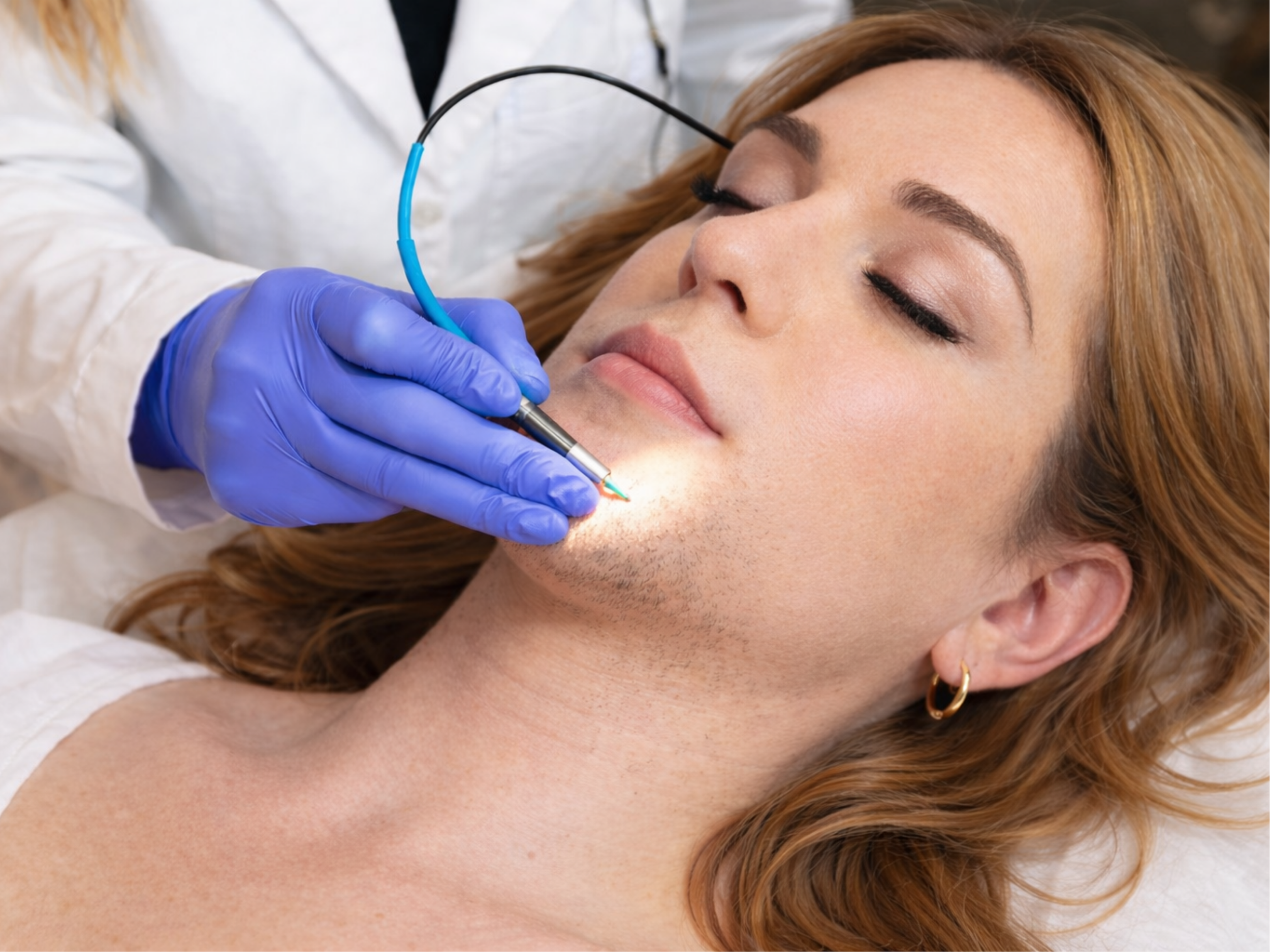 Facial electrolysis treatment for gender-affirming hair removal performed by a Zap House professional electrologist in Saint Paul, Minnesota.