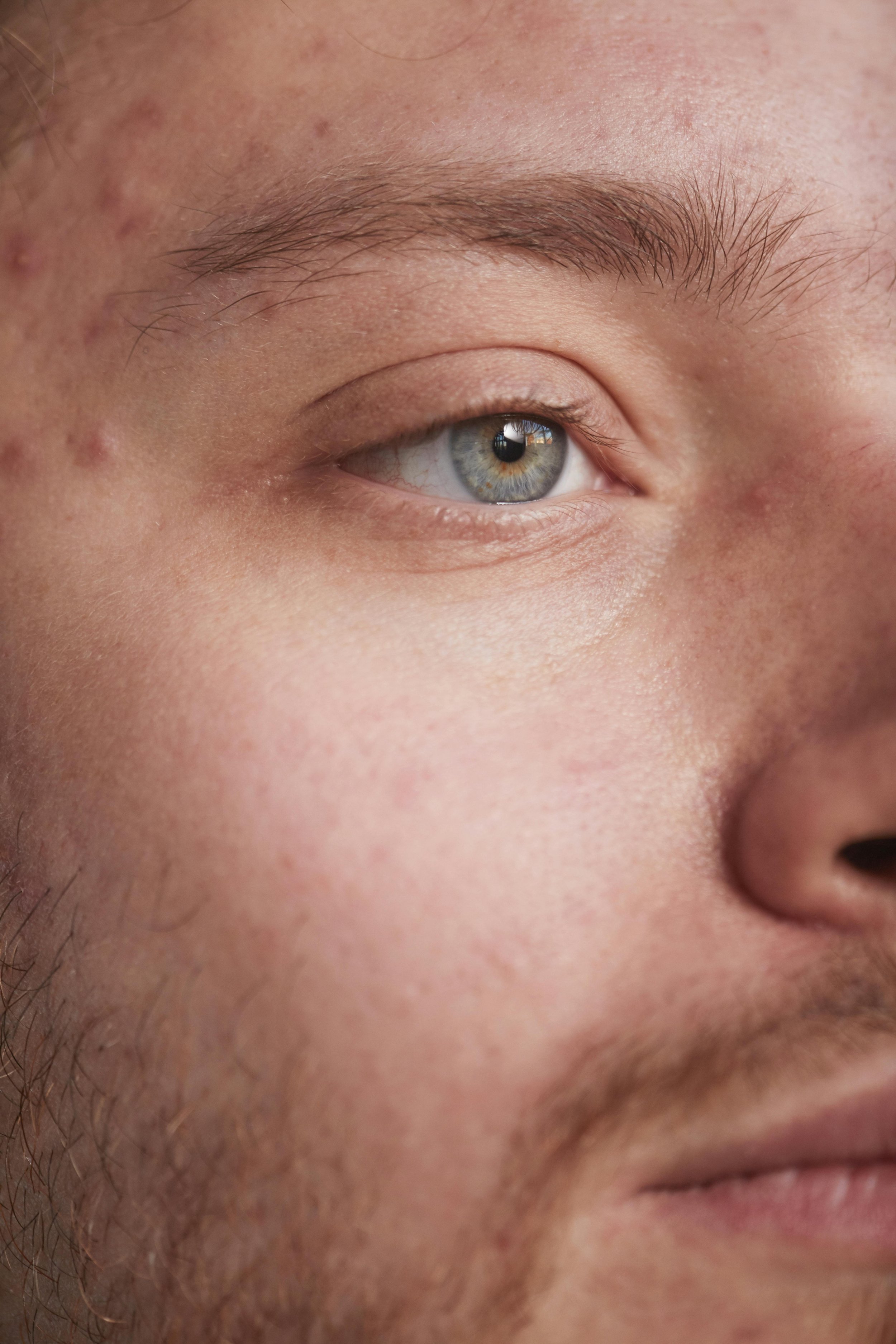 Close-up of facial skin texture representing acne and skin conditions treated at OLE BERLIN.