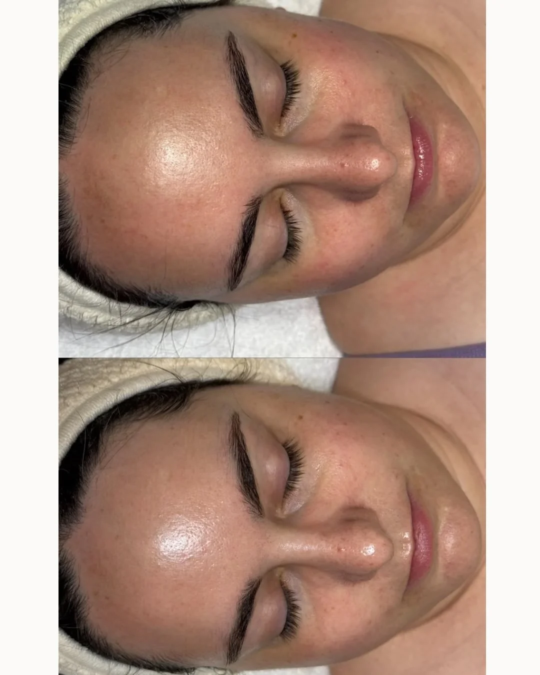 Microneedling is truly an underrated treatment 💖 

These results are from 1 infusion facial and 2 microneedling sessions (photo taken before 3rd and final session) 

We noticed reduced redness, smoother texture, increased hydration, and overall firm