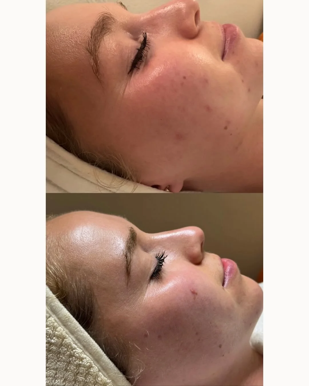 Acne isn&rsquo;t just a cosmetic concern, it&rsquo;s an ecosystem with both internal and external contributors 

When we take the time to understand why your skin is breaking out, we can create a plan that supports real, lasting results 

Being acne 