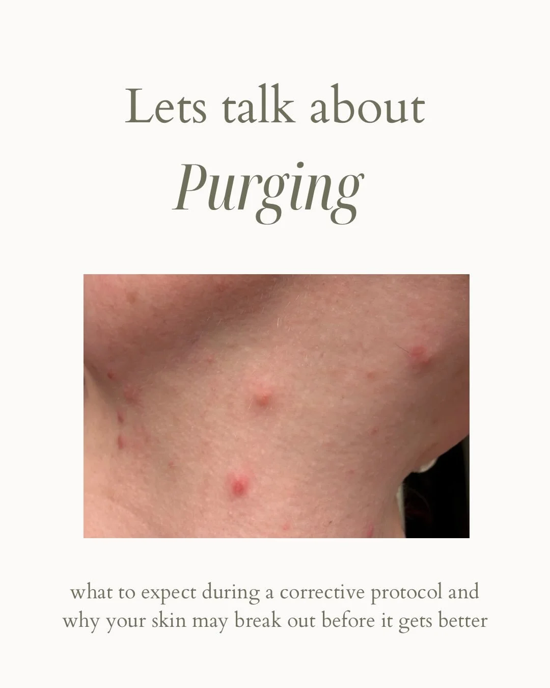 Breaking out after starting something new can feel discouraging

but purging isn&rsquo;t a setback, it&rsquo;s a temporary part of the process

Swipe to learn what purging is, why it happens, and how to support your skin through it