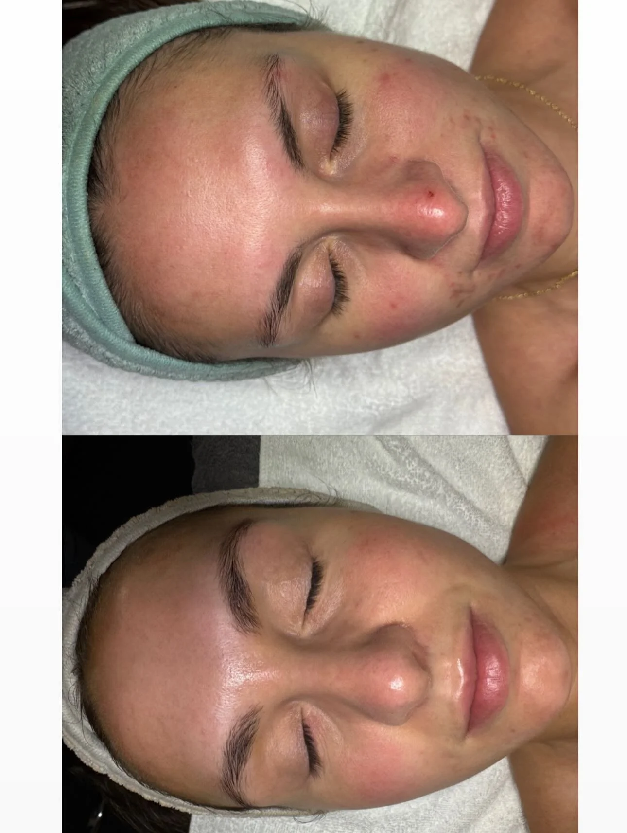Perioral dermatitis can be stubborn and so frustrating to deal with, especially in the Colorado climate with the lack of humidity. 

It&rsquo;s often a signal of your skin barrier and sometimes internal health asking for a little extra support. 

If 