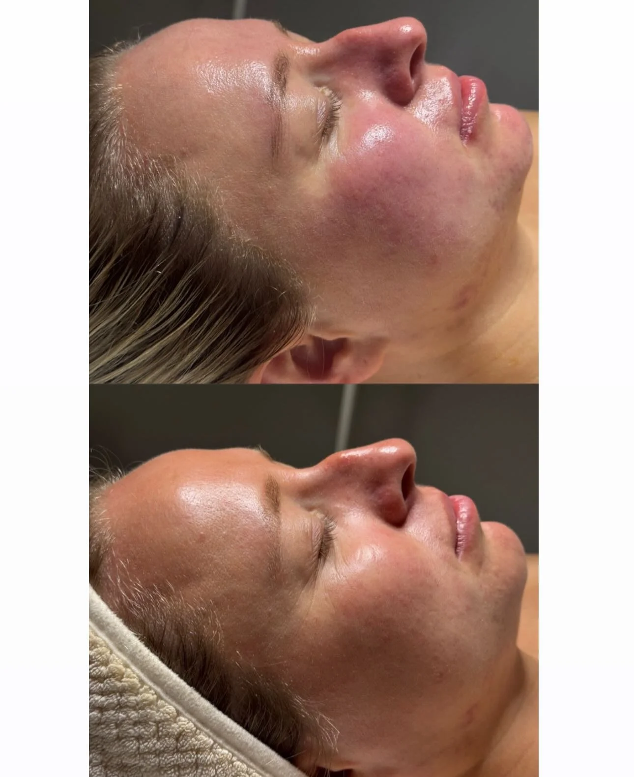 Sometimes clearing skin isn&rsquo;t about adding more products but figuring out what&rsquo;s changed 

When this client started experiencing sensitized skin and jawline breakouts that weren&rsquo;t typical for her, we went into detective mode 🕵🏻&zw
