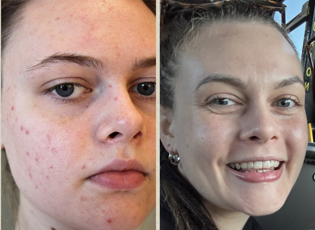 Close-up of Roeshelle Back with acne on her face, before and after skin treatment.
