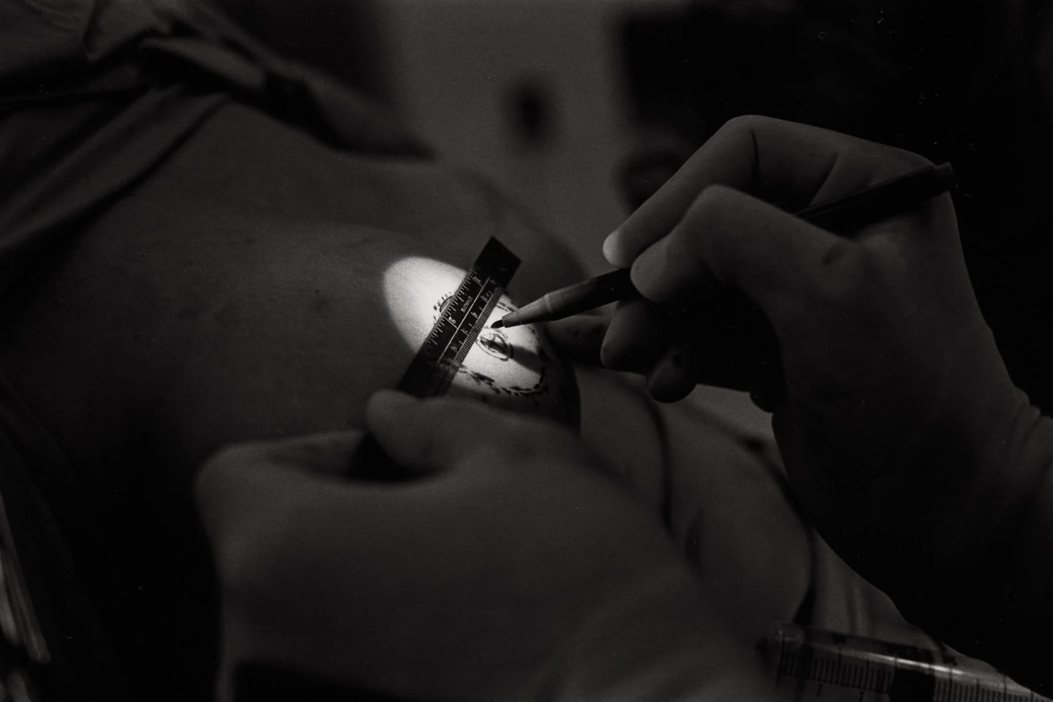 A dark frame with a small spot of light on a woman's chest, only a few inches across, as a surgeon holds a small ruler and a marker, creating guidelines for where he will cut as he fashions a nipple out of folds of skin.