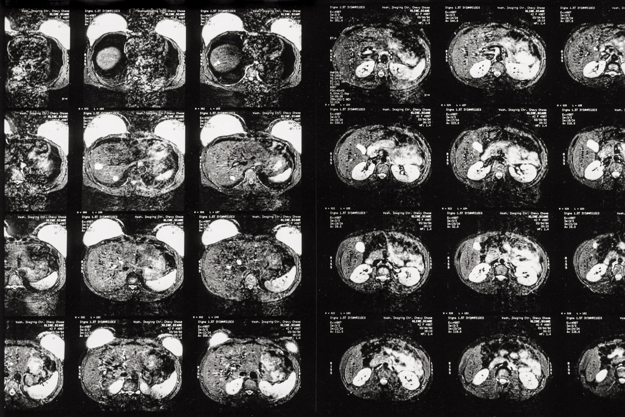 Images from an MRI scan following a recurrence of breast cancer. They are slices of the abdomen near the breast, the breasts mostly opaque as they are saline implants.