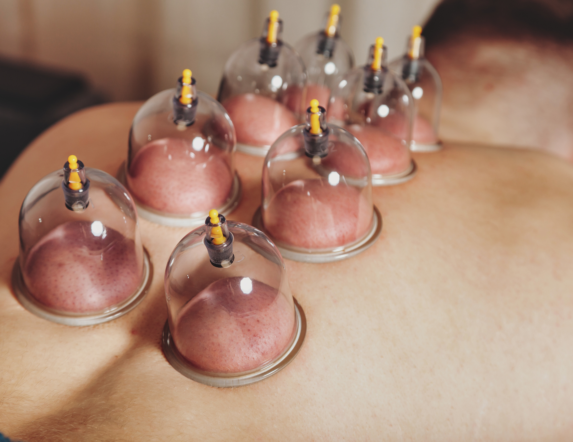 Cupping Therapy: What It Is, How It Works, and What It's Good For