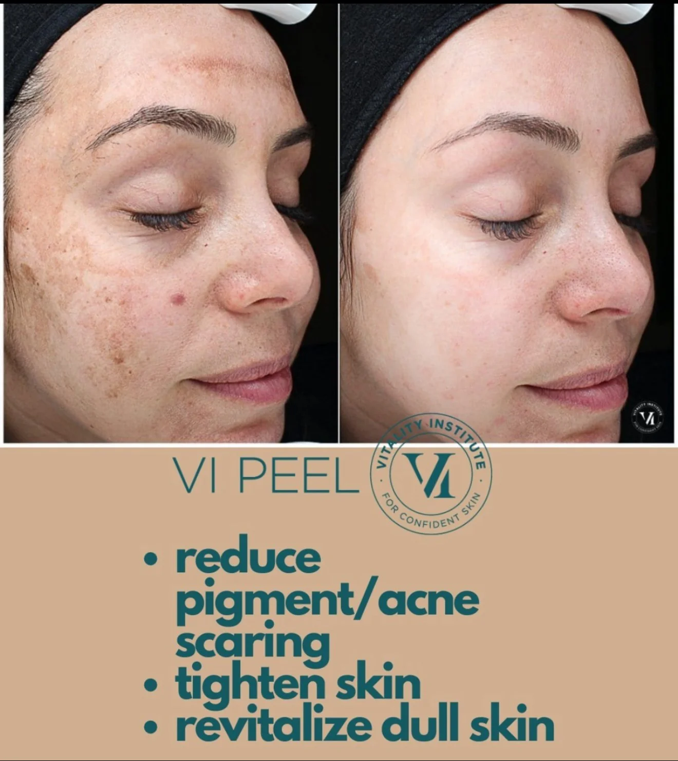 Before and After Results of VI Peel Treatment