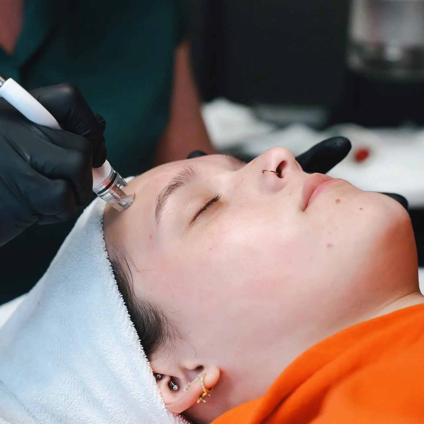 Facial microneedling in progress by licensed esthetician