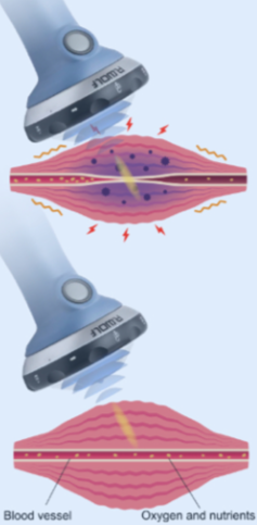 Diagram showing a device targeting a muscle with light or laser therapy, illustrating muscle tissue and blood vessels with oxygen and nutrients, highlighting healing effects.