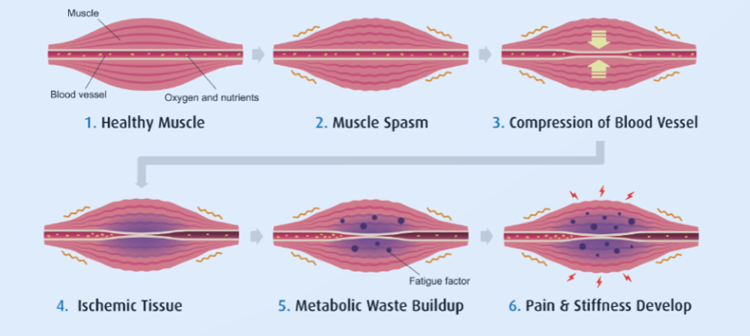 Diagram illustrating muscle condition progression from healthy muscle to pain and stiffness, showing stages: 1. Healthy muscle with normal blood flow, 2. Muscle spasm, 3. Blood vessel compression, 4. Ischemic tissue, 5. Metabolic waste buildup, 6. Pain and stiffness development.