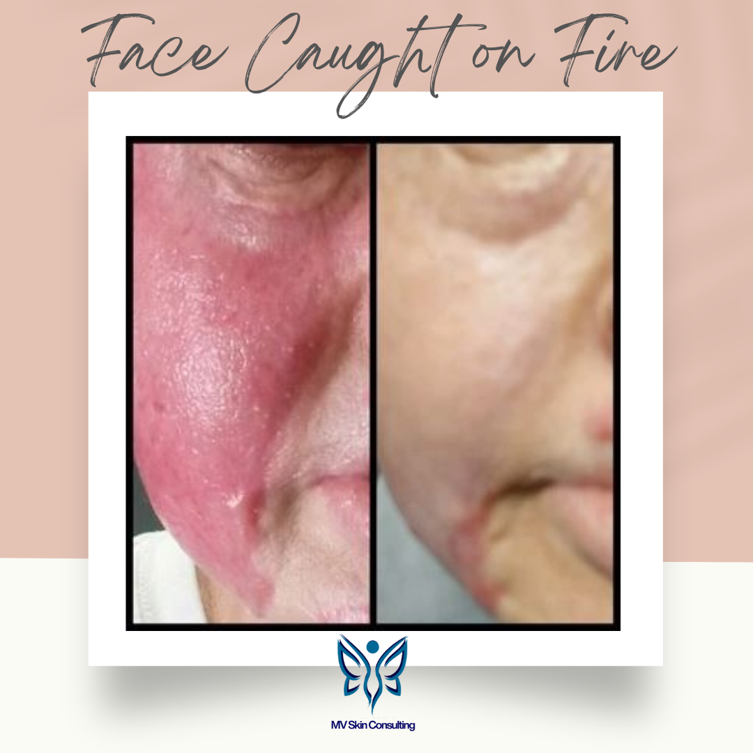 MV Skin Consulting helped this client restore function in her facial muscles and skin, from burns with gentle natural techniques, in Richardson, Texas