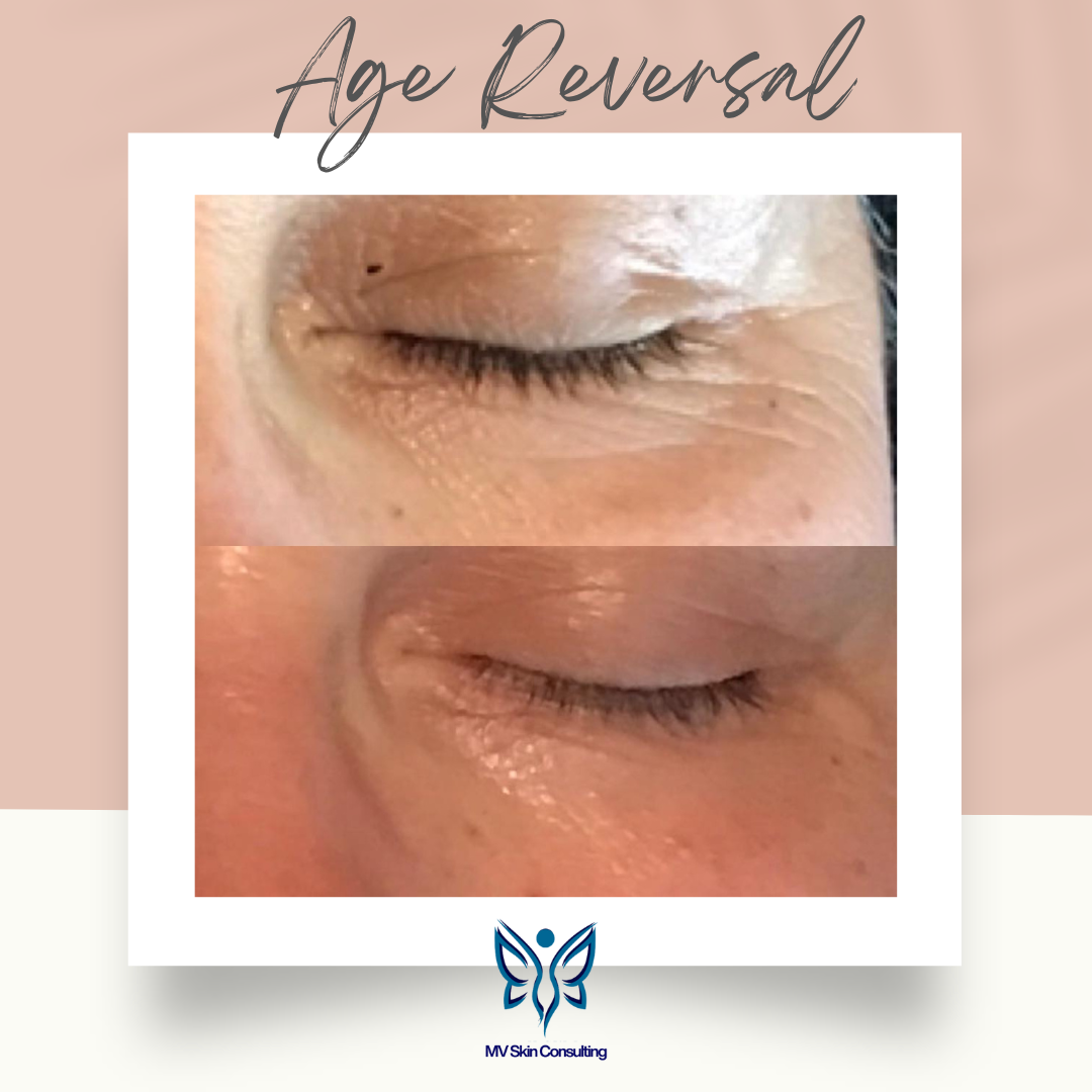 In Richardson, Texas MV Skin Consulting's natural age reversal facials can reverse the lines around client's eye, pictures are same day,  pre and post facial without needles or harsh products.