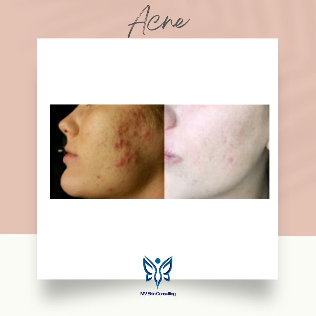 Acne healed gently and naturally, MV Skin Consulting-in Richardson