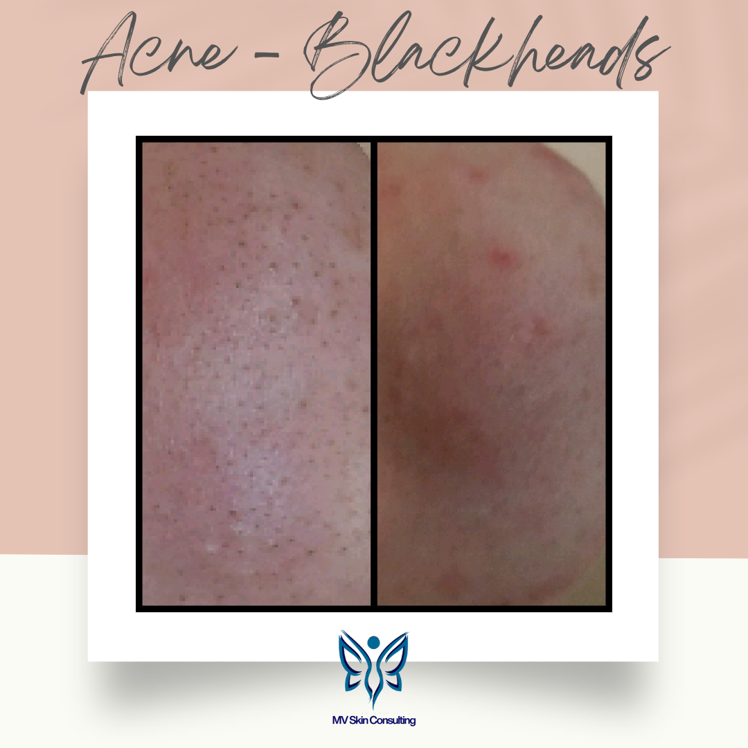 Located in Richardson, Texas, MV Skin Consulting's approach to blackheads is natural and gentle; she does NOT do extractions..