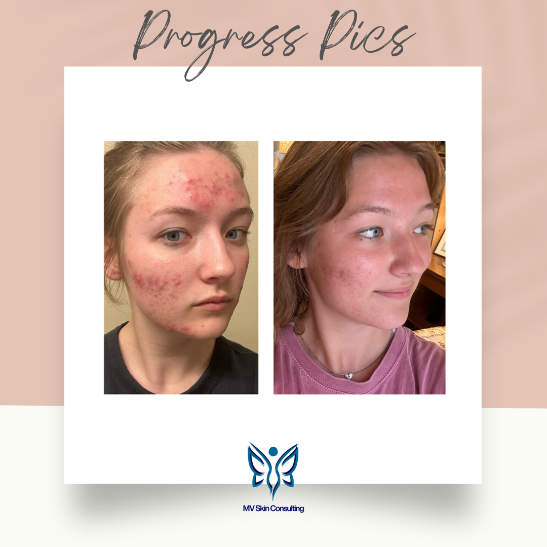 Progress pictures are important, we can see more than just her skin healing in this picture, she is looking happier seeing her skin heal-by MV Skin Consulting, Richardson
