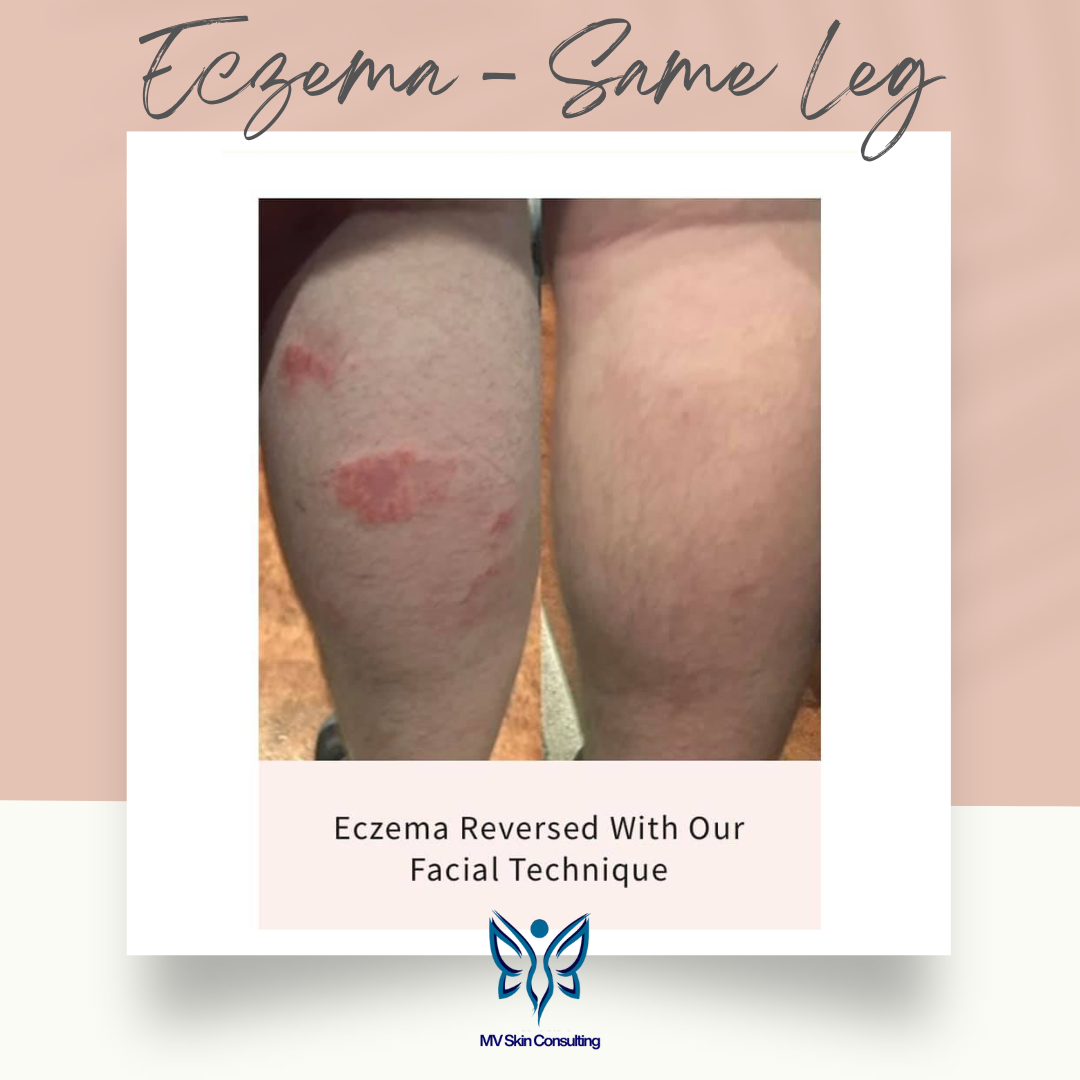 Eczema healed with MV Skin Consulting's holistic facial rebalancing system; the leg was never touched; near Plano and North Dallas