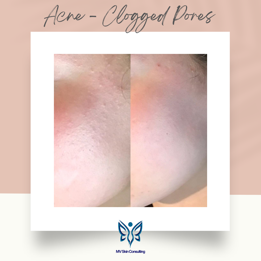 MV Skin Consulting believes in a natural and gentle approach to healing skin conditions, that includes clogged pores