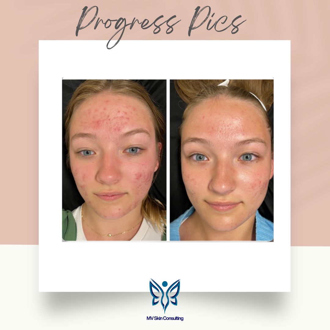 Acne impacts emotions and confidence, we can see positive changes in her skin and the sparkle in her eyes is returning already, MV Skin Consulting located in Richardson