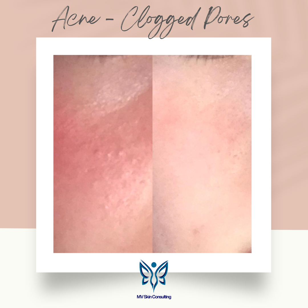 Located near North Dallas, MV Skin Consulting approaches clogged pores as the need for supportive protocols, and not agree with the use of harsh products or extractions