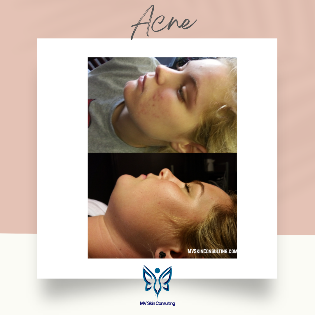 Acne healed naturally by MV Skin Consulting in Richardson, TX